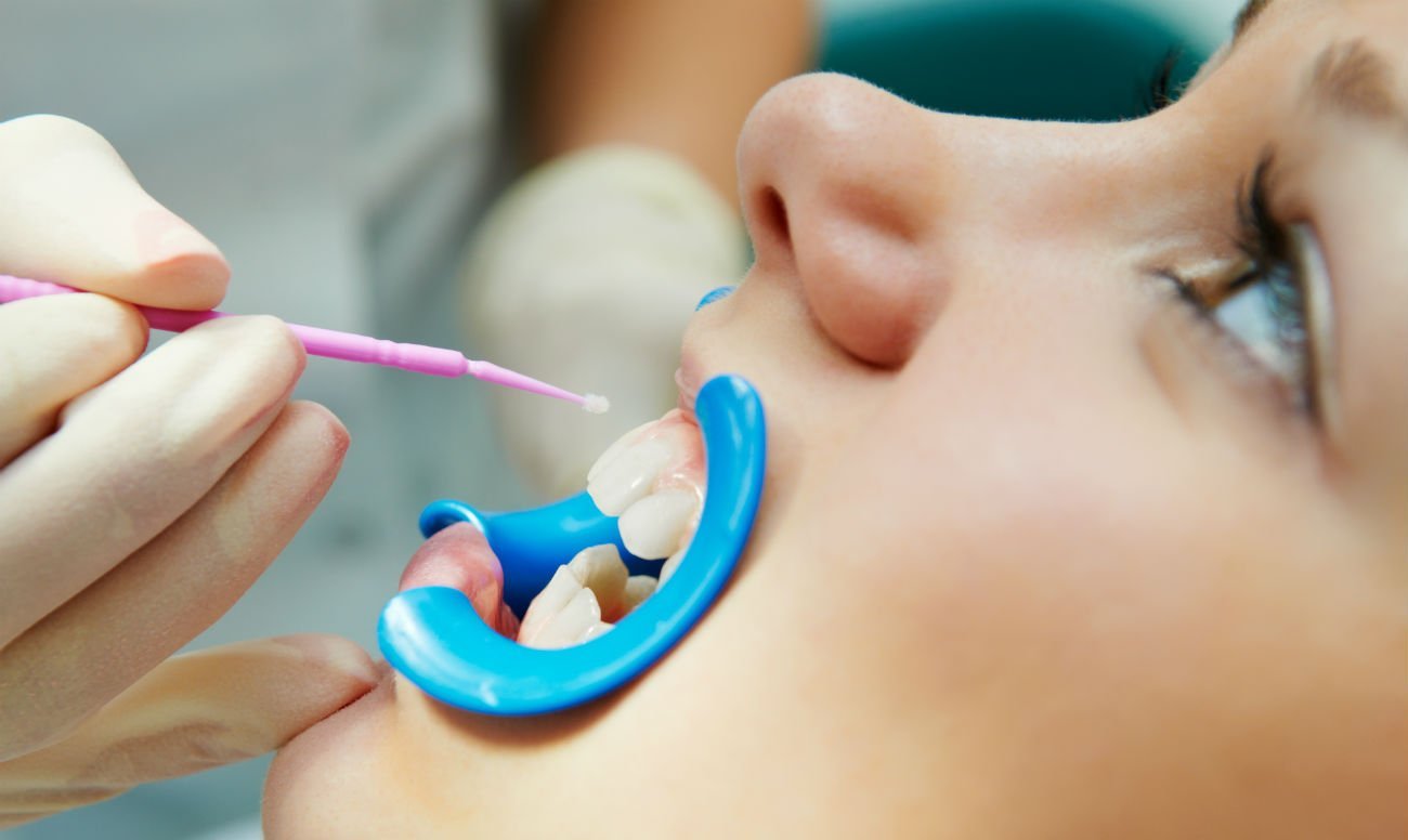 Чи можна і як зміцнити зубну емаль в домашніх умовах?