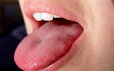 Чому болить корінь язика?