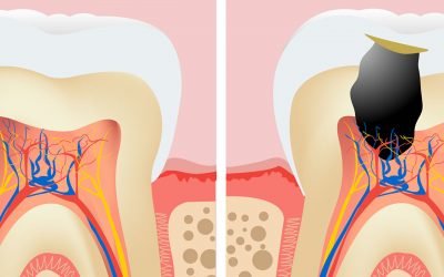 Чому після лікування пульпіту може захворіти зуб?