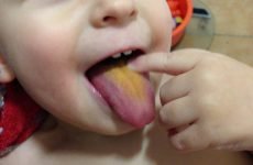 Чому у дітей з’являється жовтий наліт на язиці?