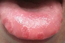 Чому виникають виразки на язиці у дитини і як з ними боротися?