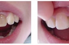 Проводиться відбілювання зубів, в яких є пломби?