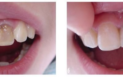 Проводиться відбілювання зубів, в яких є пломби?
