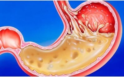 Симптоми й лікування гастриту шлунка з підвищеною кислотністю