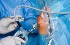 Артроскопія передньої хрестоподібної зв’язки колінного суглоба — вартість і переваги процедури, можливі ускладнення