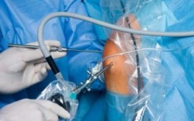 Артроскопія передньої хрестоподібної зв’язки колінного суглоба — вартість і переваги процедури, можливі ускладнення