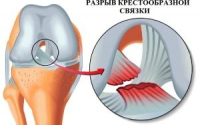 Дегенеративні зміни передньої хрестоподібної зв’язки колінного суглоба і часткові пошкодження хрестів коліна