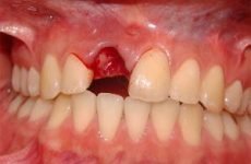Як зупинити кров після видалення зуба, що робити при кровотечі якщо вирваний зуб мудрості