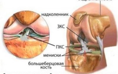Лигаментоз хрестоподібних зв’язок колінного суглоба — лікування та причини, наслідки і ускладнення захворювання