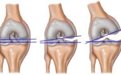 Розрив хрестоподібної зв’язки колінного суглоба — симптоми і лікування, наслідки та ускладнення пошкодження