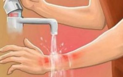 Опік парою — що робити в домашніх умовах, перша допомога якщо обпекла (ошпарила) руку або пальці і чим лікувати опік