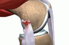 Пошкодження задньої хрестоподібної зв’язки колінного суглоба — розрив, надрив і відрив заднього хреста