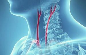 prichiny, simptomy i lechenie anevrizmy sonnojj arterii v oblasti shei115