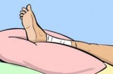 Розтягнення литкового м’яза — симптоми і лікування вдома мазями, що робити якщо потягнув м’яз на нозі і як лікувати