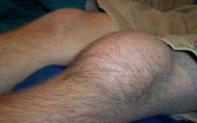 Розтягнення зв’язок колінного суглоба — симптоми і лікування, що робити якщо потягнула підколінне сухожилля і м’язи, зв’язки коліна