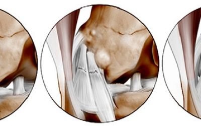 Розрив передньої хрестоподібної зв’язки колінного суглоба — лікування і симптоми ушкоджень, терапія лигаментоза