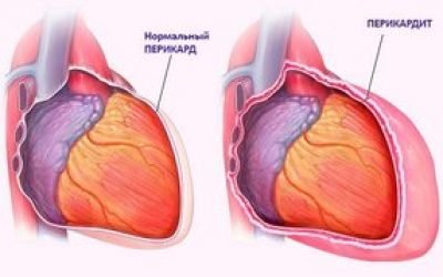 Симптоми і лікування перикардиту — запалення серцевої сумки