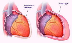 Симптоми і лікування перикардиту — запалення серцевої сумки