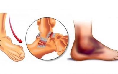 Вивих стопи — симптоми і лікування, ознаки перелому, тріщини і пошкодження гомілковостопного суглоба, перша допомога при травмі