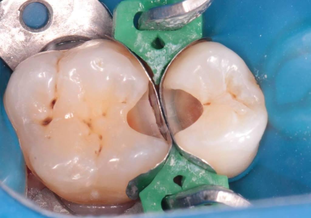 Що характерно для карієсу між зубами і чому він виникає?