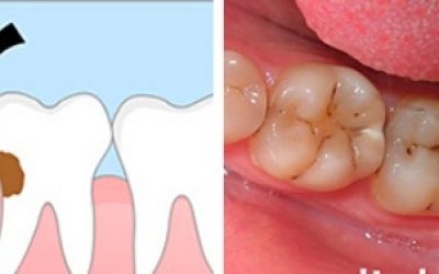 Що характерно для карієсу на зубі мудрості і як його лікувати?