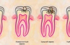 Особливості карієсу кореня зуба і його лікування