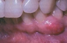 Особливості кистогранулемы зуба і рекомендації з лікування