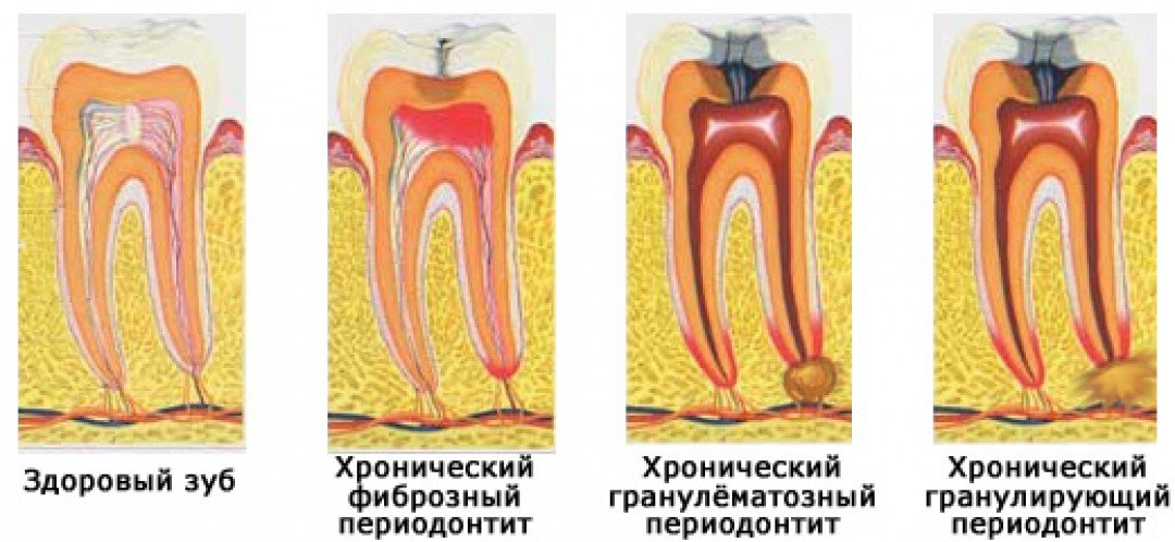 chto kharakterno dlya obostreniya khronicheskogo periodontita