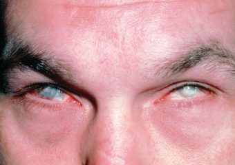 Хімічний опік шкіри — лікування в домашніх умовах мазями, фото опіку рогівки ока та надання першої долікарської допомоги