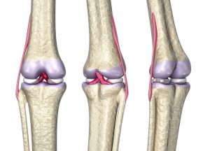 Розрив звязок колінного суглоба — лікування й терміни відновлення, симптоми та ознаки часткового надриву бічної звязки