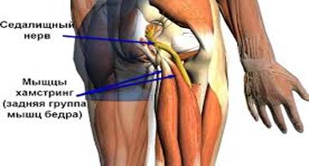 Надрив задньої поверхні стегна — терміни відновлення і лікування, симптоми відриву та розриву звязок і мязів