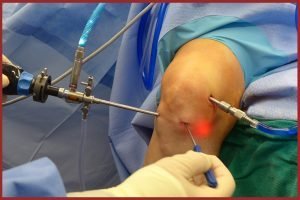 Операція на звязки колінного суглоба і період відновлення, реабілітація після заміни і зшивання звязок коліна