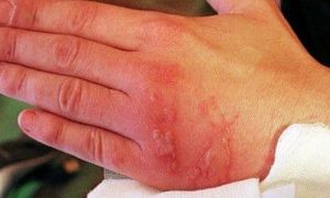 Опік Димексидом — що робити і як лікувати в домашніх умовах, наслідки опіку шкіри на: пальці, долоні і пяті