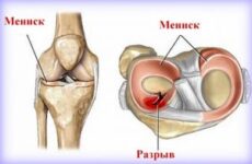 Розрив меніска колінного суглоба — лікування без операції, як лікувати надрив і тріщину меніска народними засобами