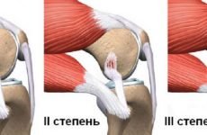Розрив зв’язувань колінного суглоба — симптоми і лікування без операції, скільки гояться і що робити якщо порвані зв’язки коліна