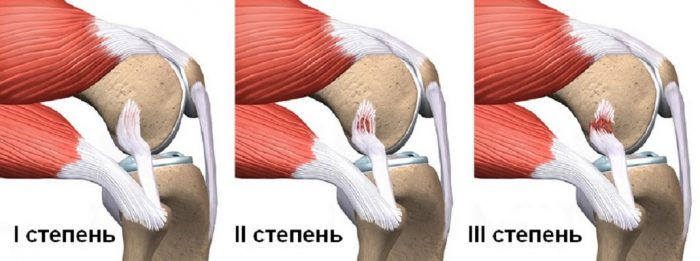 Розрив звязувань колінного суглоба — симптоми і лікування без операції, скільки гояться і що робити якщо порвані звязки коліна