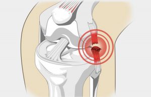 Розрив звязувань колінного суглоба — симптоми і лікування без операції, скільки гояться і що робити якщо порвані звязки коліна