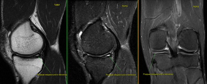 Розрив заднього рогу медіального меніска колінного суглоба, лікування горизонтального і дегенеративного внутрішнього меніска коліна