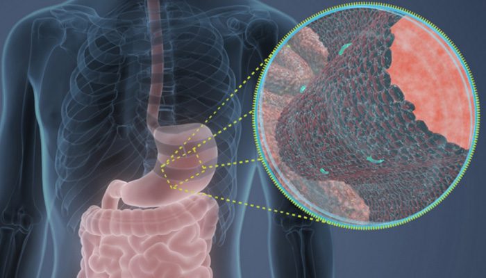 Причини інфільтративного раку шлунка, його діагностика та лікування