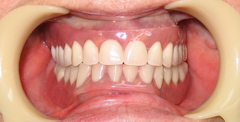 Акрилові зубні протези: різновиди, переваги, особливості догляду