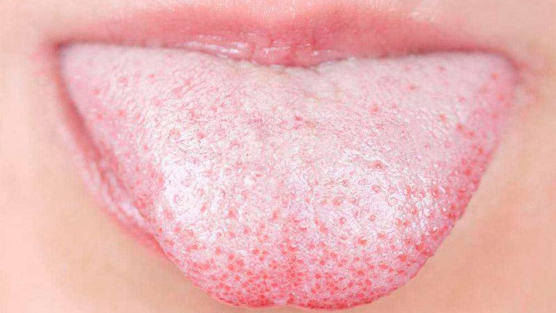 Білий наліт на язиці у дорослих: причини і методи лікування