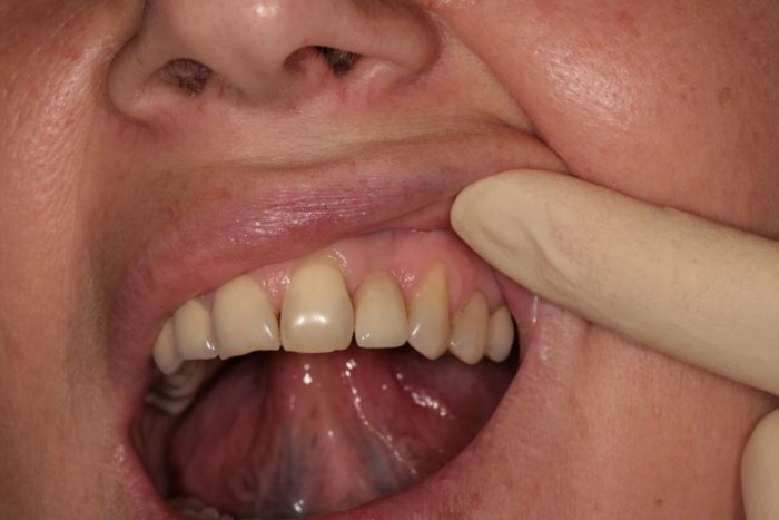 Болить передній зуб: причини і методи лікування
