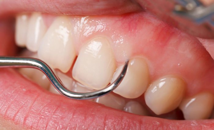 Болить передній зуб: причини і методи лікування