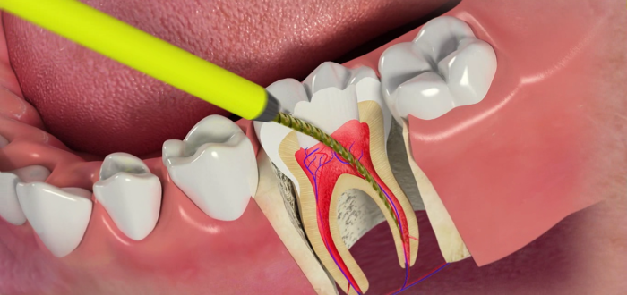 Болить зуб після пломбування при накусывании: причини і лікування