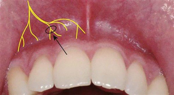 Боляче лікувати зуби: особливості анестезії, відгуки