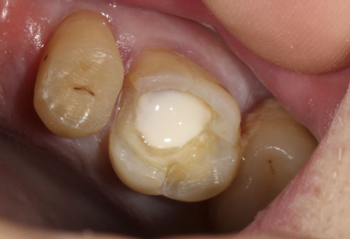 Що робити, якщо випала пломба з зуба: причини, чому небезпечно і як вирішити проблему