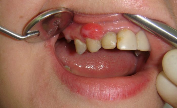 Свищ після видалення зуба: причини, ускладнення та методи лікування