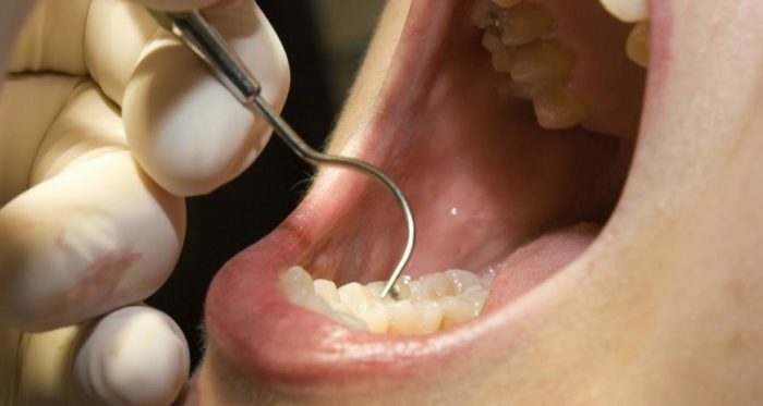 Свищ після видалення зуба: причини, ускладнення та методи лікування