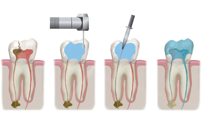 Гранульома зуба: причини появи та методи лікування
