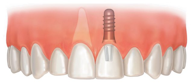 Як проводиться імплантація верхніх передніх зубів